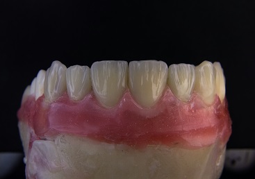 3D Printing Dental Implants